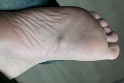 Relief Options for Plantar Fibromas