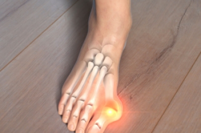 Understanding Bunions