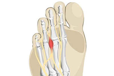 What Is Morton’s Neuroma?