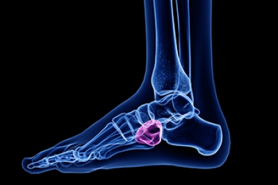 Misdiagnosed Foot Pain From Cuboid Syndrome