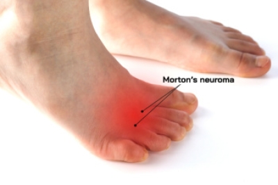 Understanding Morton's Neuroma